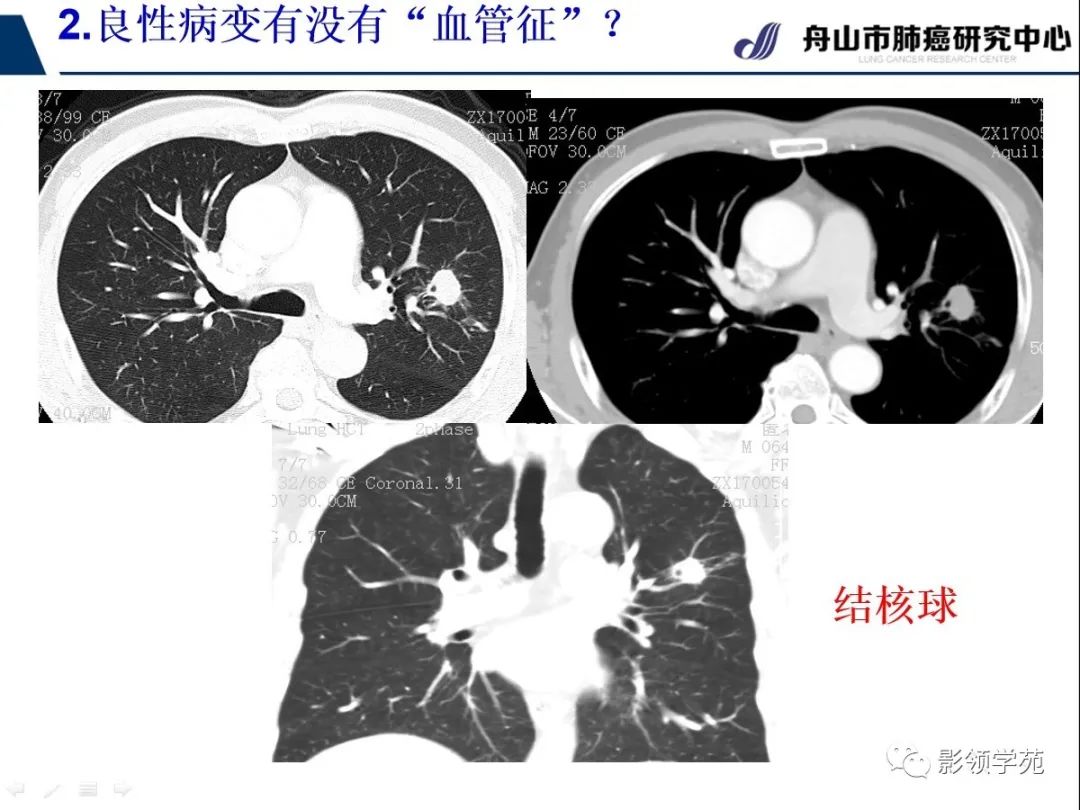 影像PPT - 【PPT】CT征象对早期肺腺癌亚型分型价值探讨—血管征-28 影像PPT - 【PPT】CT征象对早期肺腺癌亚型分型价值探讨—血管征-28