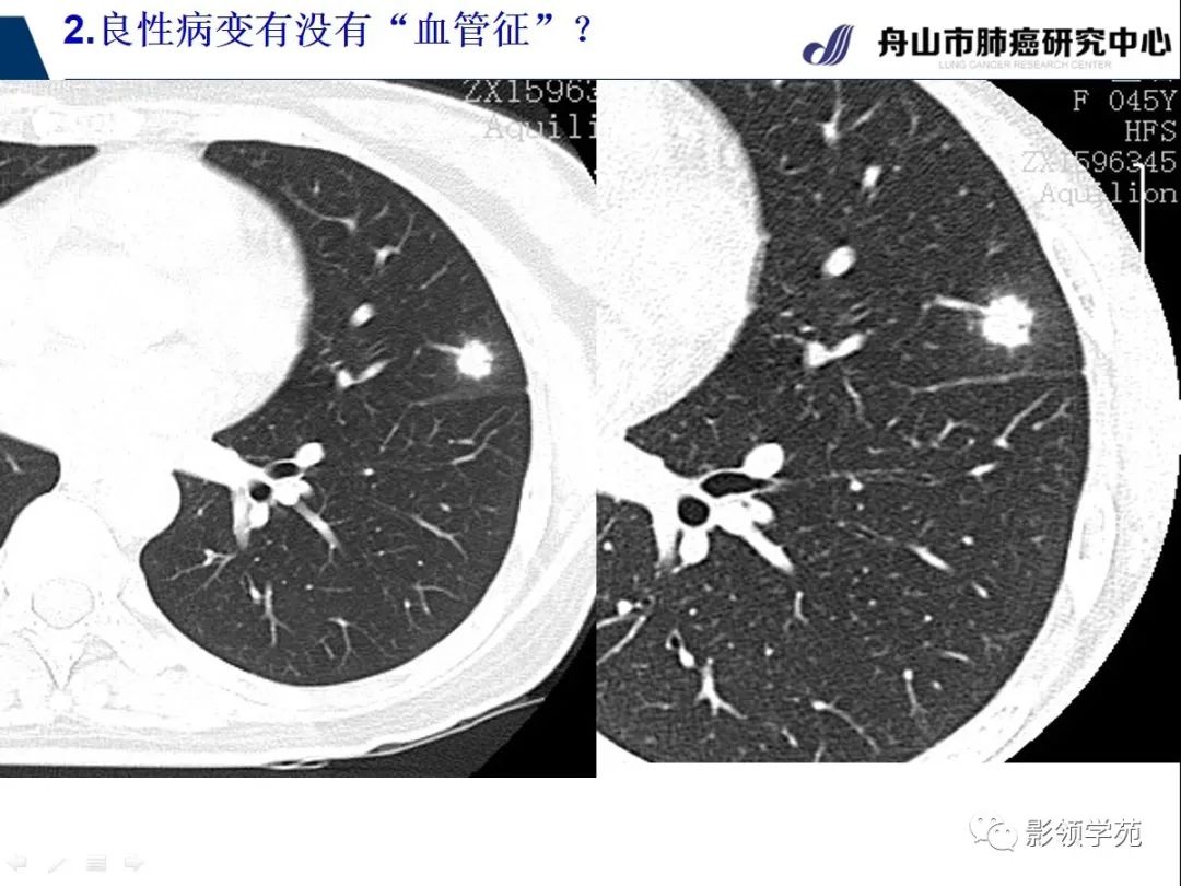影像PPT - 【PPT】CT征象对早期肺腺癌亚型分型价值探讨—血管征-29 影像PPT - 【PPT】CT征象对早期肺腺癌亚型分型价值探讨—血管征-29
