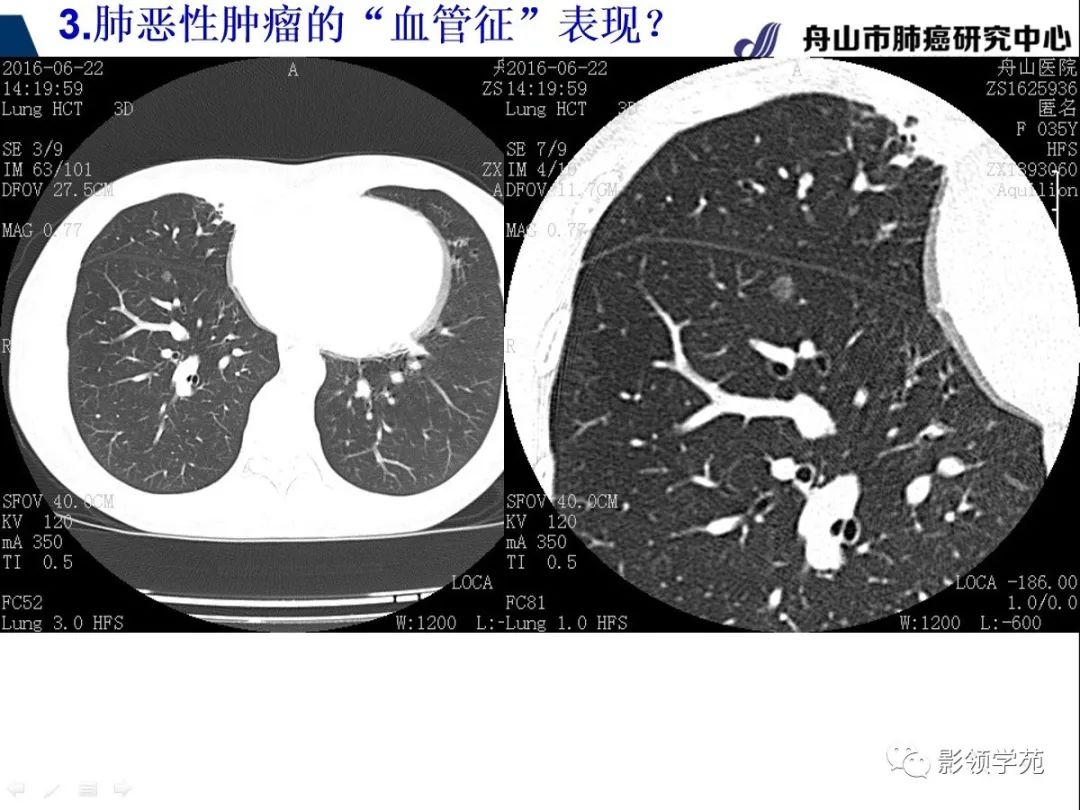 影像PPT - 【PPT】CT征象对早期肺腺癌亚型分型价值探讨—血管征-32 影像PPT - 【PPT】CT征象对早期肺腺癌亚型分型价值探讨—血管征-32