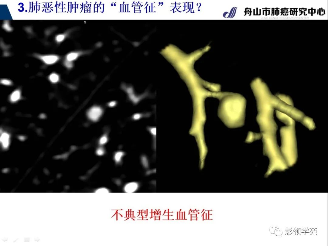 影像PPT - 【PPT】CT征象对早期肺腺癌亚型分型价值探讨—血管征-33 影像PPT - 【PPT】CT征象对早期肺腺癌亚型分型价值探讨—血管征-33