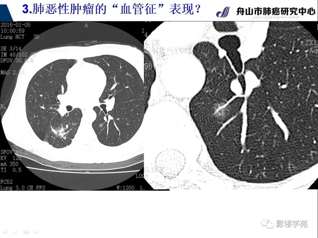 影像PPT - 【PPT】CT征象对早期肺腺癌亚型分型价值探讨—血管征-34 影像PPT - 【PPT】CT征象对早期肺腺癌亚型分型价值探讨—血管征-34