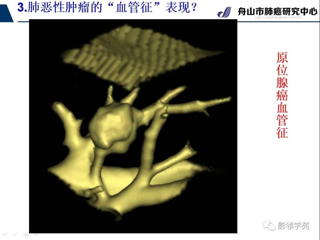 影像PPT - 【PPT】CT征象对早期肺腺癌亚型分型价值探讨—血管征-35 影像PPT - 【PPT】CT征象对早期肺腺癌亚型分型价值探讨—血管征-35