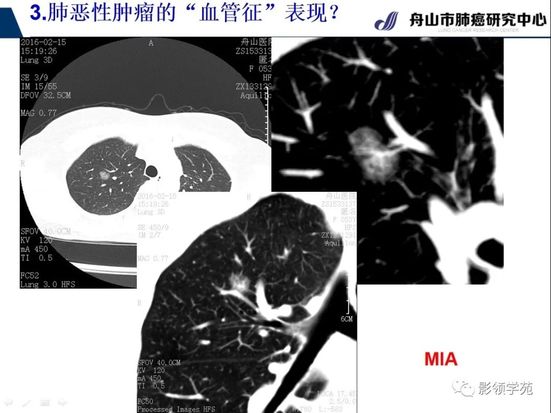 影像PPT - 【PPT】CT征象对早期肺腺癌亚型分型价值探讨—血管征-36 影像PPT - 【PPT】CT征象对早期肺腺癌亚型分型价值探讨—血管征-36