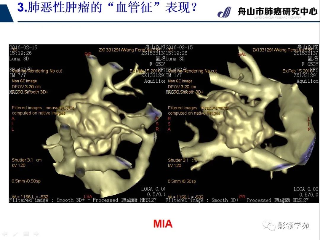 影像PPT - 【PPT】CT征象对早期肺腺癌亚型分型价值探讨—血管征-37 影像PPT - 【PPT】CT征象对早期肺腺癌亚型分型价值探讨—血管征-37