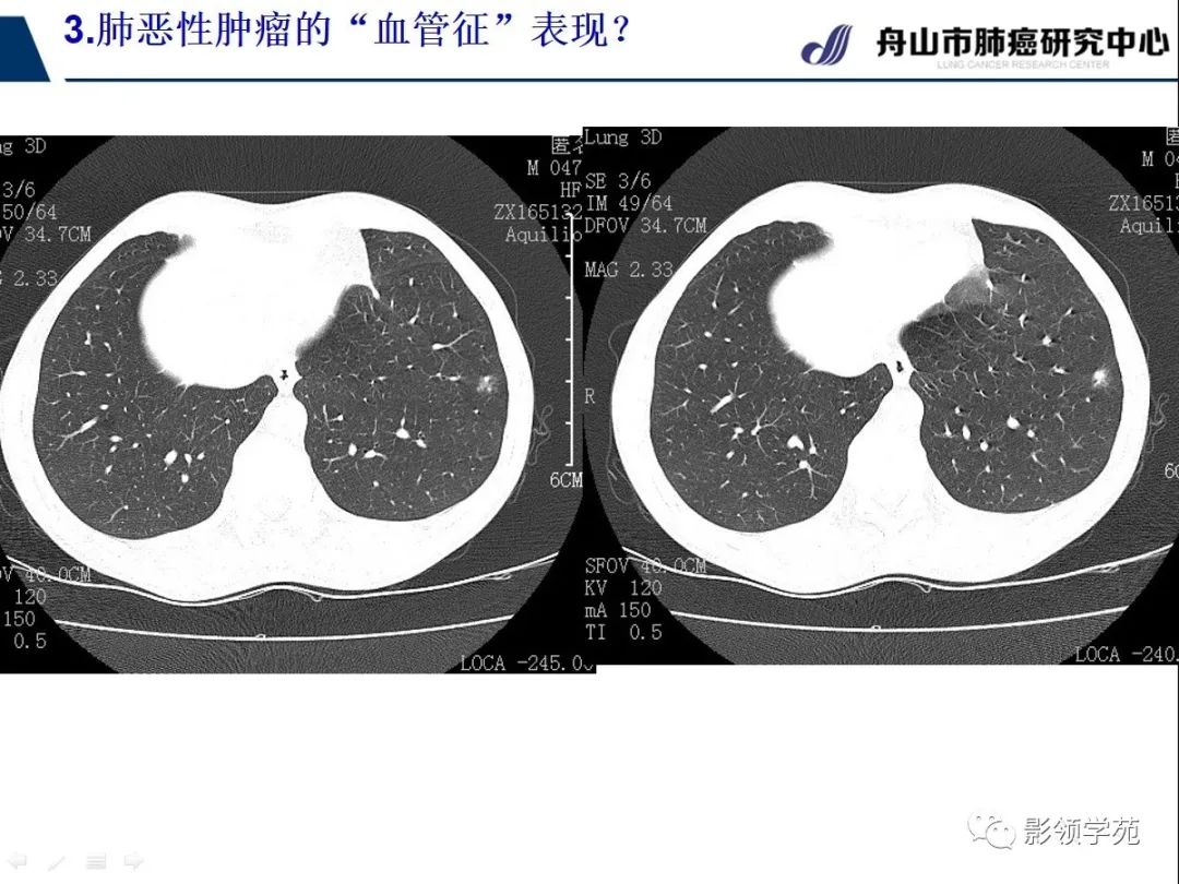 影像PPT - 【PPT】CT征象对早期肺腺癌亚型分型价值探讨—血管征-38 影像PPT - 【PPT】CT征象对早期肺腺癌亚型分型价值探讨—血管征-38