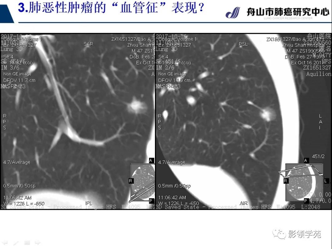 影像PPT - 【PPT】CT征象对早期肺腺癌亚型分型价值探讨—血管征-39 影像PPT - 【PPT】CT征象对早期肺腺癌亚型分型价值探讨—血管征-39