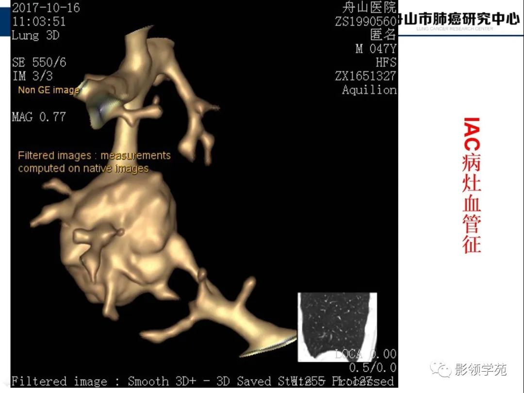 影像PPT - 【PPT】CT征象对早期肺腺癌亚型分型价值探讨—血管征-40 影像PPT - 【PPT】CT征象对早期肺腺癌亚型分型价值探讨—血管征-40