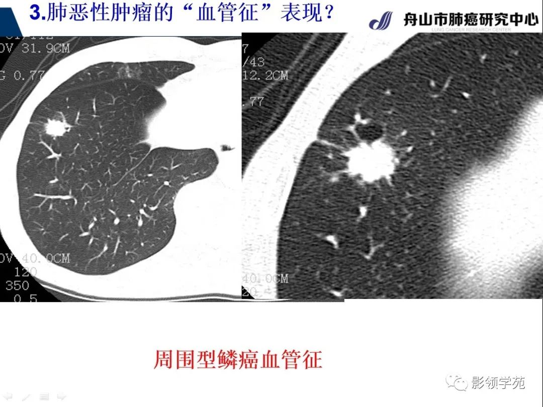 影像PPT - 【PPT】CT征象对早期肺腺癌亚型分型价值探讨—血管征-41 影像PPT - 【PPT】CT征象对早期肺腺癌亚型分型价值探讨—血管征-41