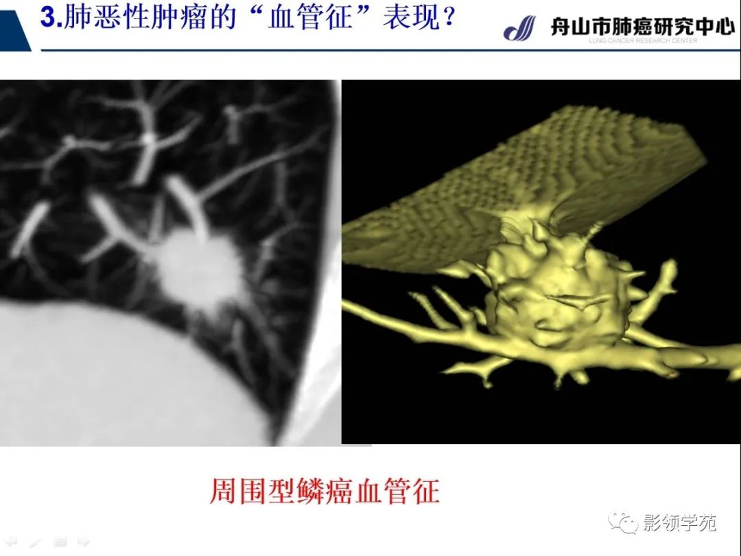影像PPT - 【PPT】CT征象对早期肺腺癌亚型分型价值探讨—血管征-42 影像PPT - 【PPT】CT征象对早期肺腺癌亚型分型价值探讨—血管征-42