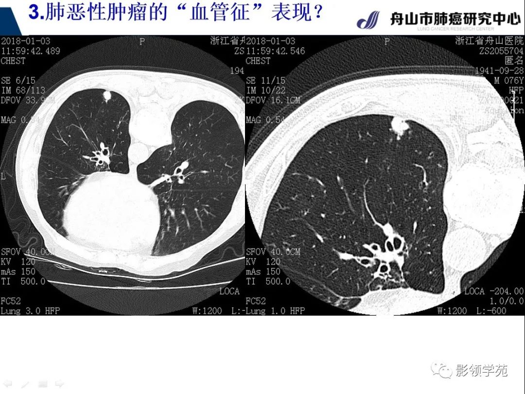影像PPT - 【PPT】CT征象对早期肺腺癌亚型分型价值探讨—血管征-43 影像PPT - 【PPT】CT征象对早期肺腺癌亚型分型价值探讨—血管征-43