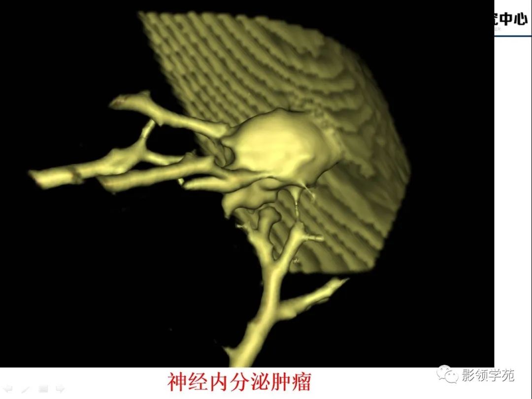 影像PPT - 【PPT】CT征象对早期肺腺癌亚型分型价值探讨—血管征-45 影像PPT - 【PPT】CT征象对早期肺腺癌亚型分型价值探讨—血管征-45