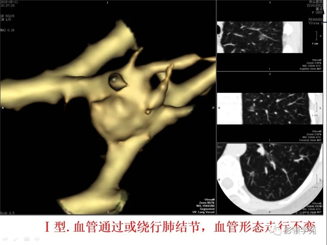 影像PPT - 【PPT】CT征象对早期肺腺癌亚型分型价值探讨—血管征-48 影像PPT - 【PPT】CT征象对早期肺腺癌亚型分型价值探讨—血管征-48