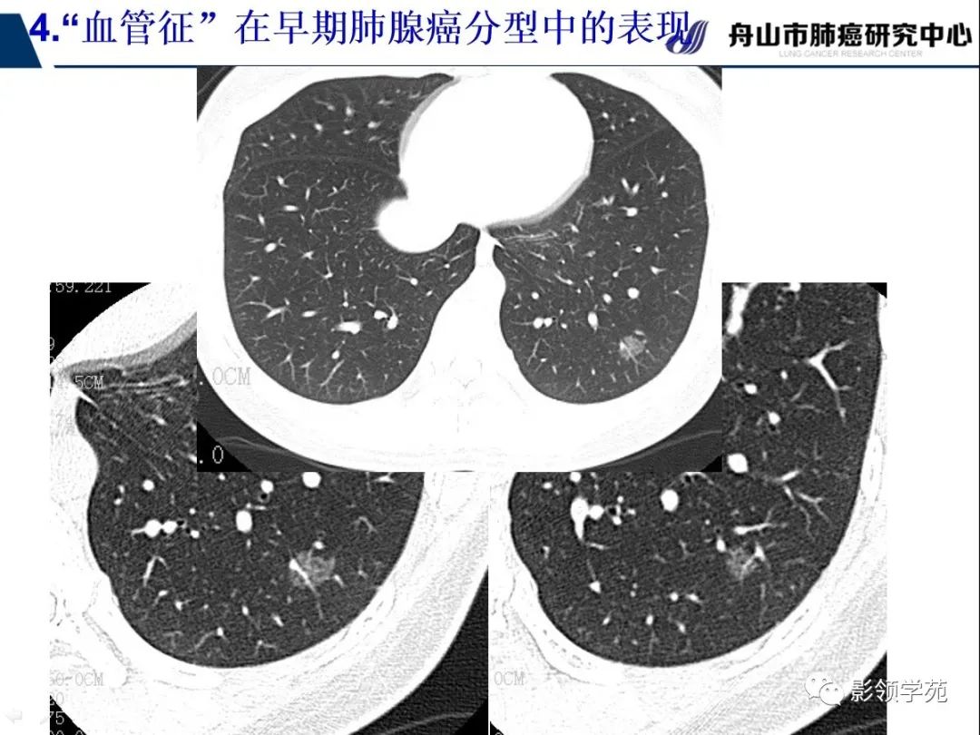影像PPT - 【PPT】CT征象对早期肺腺癌亚型分型价值探讨—血管征-49 影像PPT - 【PPT】CT征象对早期肺腺癌亚型分型价值探讨—血管征-49