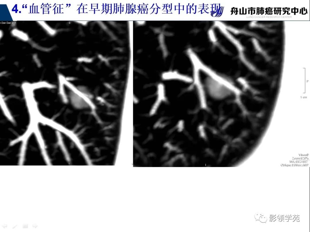 影像PPT - 【PPT】CT征象对早期肺腺癌亚型分型价值探讨—血管征-50 影像PPT - 【PPT】CT征象对早期肺腺癌亚型分型价值探讨—血管征-50