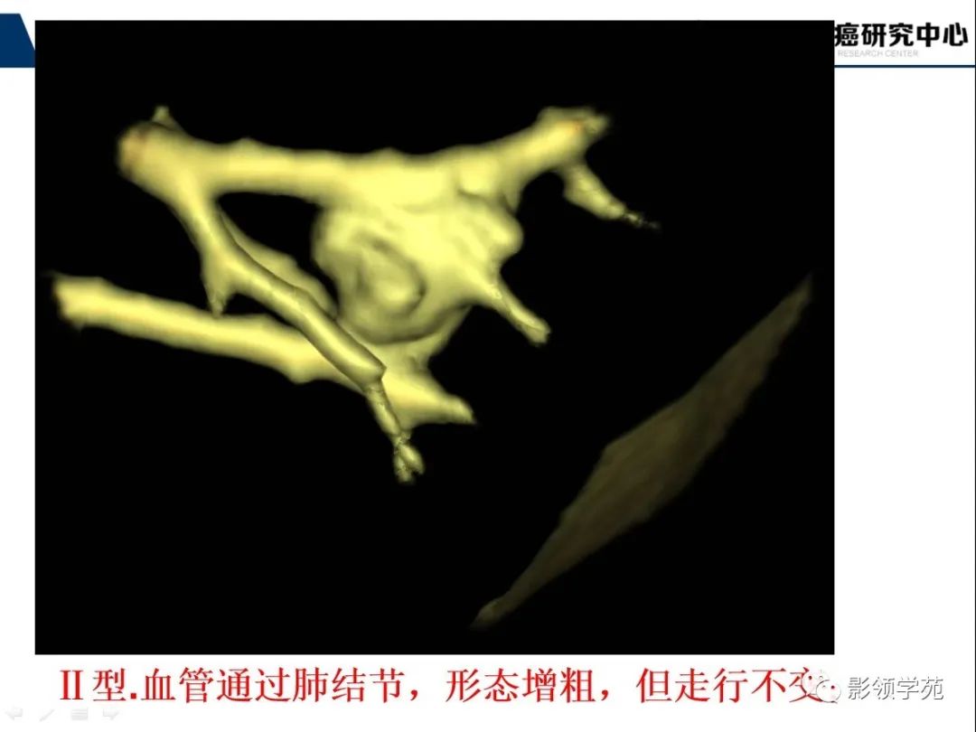 影像PPT - 【PPT】CT征象对早期肺腺癌亚型分型价值探讨—血管征-51 影像PPT - 【PPT】CT征象对早期肺腺癌亚型分型价值探讨—血管征-51