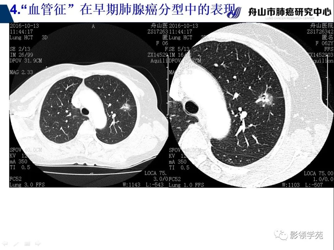 影像PPT - 【PPT】CT征象对早期肺腺癌亚型分型价值探讨—血管征-52 影像PPT - 【PPT】CT征象对早期肺腺癌亚型分型价值探讨—血管征-52