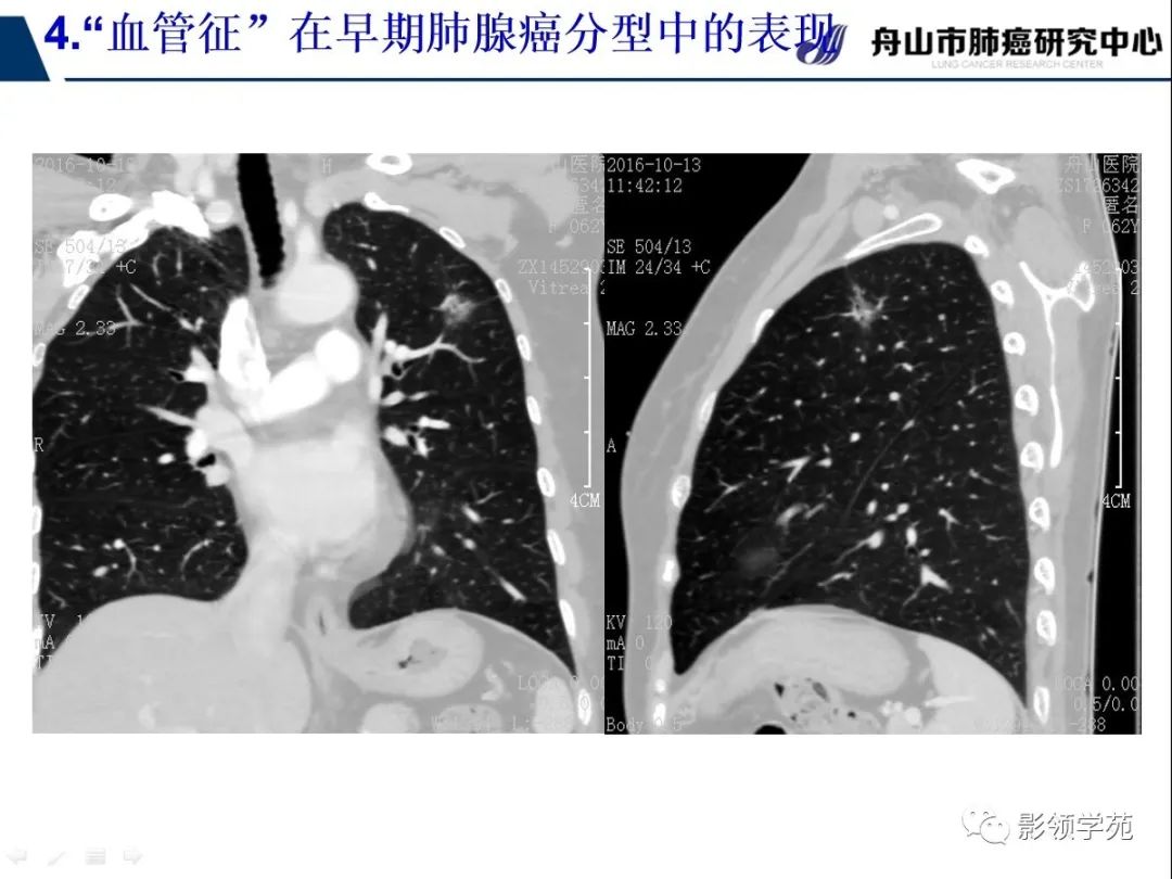 影像PPT - 【PPT】CT征象对早期肺腺癌亚型分型价值探讨—血管征-53 影像PPT - 【PPT】CT征象对早期肺腺癌亚型分型价值探讨—血管征-53