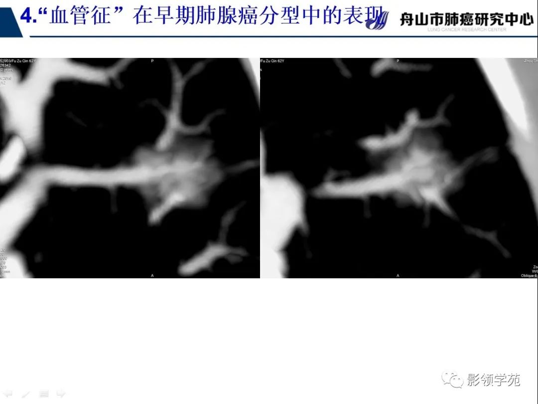 影像PPT - 【PPT】CT征象对早期肺腺癌亚型分型价值探讨—血管征-54 影像PPT - 【PPT】CT征象对早期肺腺癌亚型分型价值探讨—血管征-54
