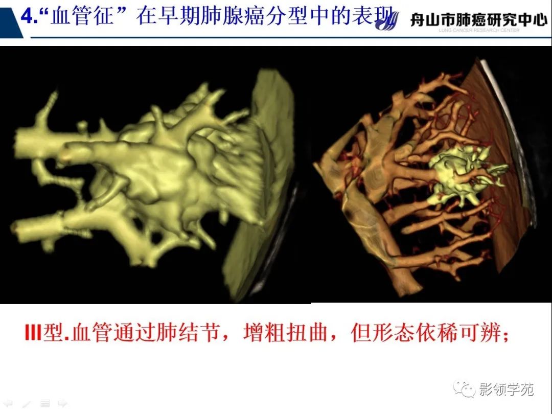 影像PPT - 【PPT】CT征象对早期肺腺癌亚型分型价值探讨—血管征-55 影像PPT - 【PPT】CT征象对早期肺腺癌亚型分型价值探讨—血管征-55