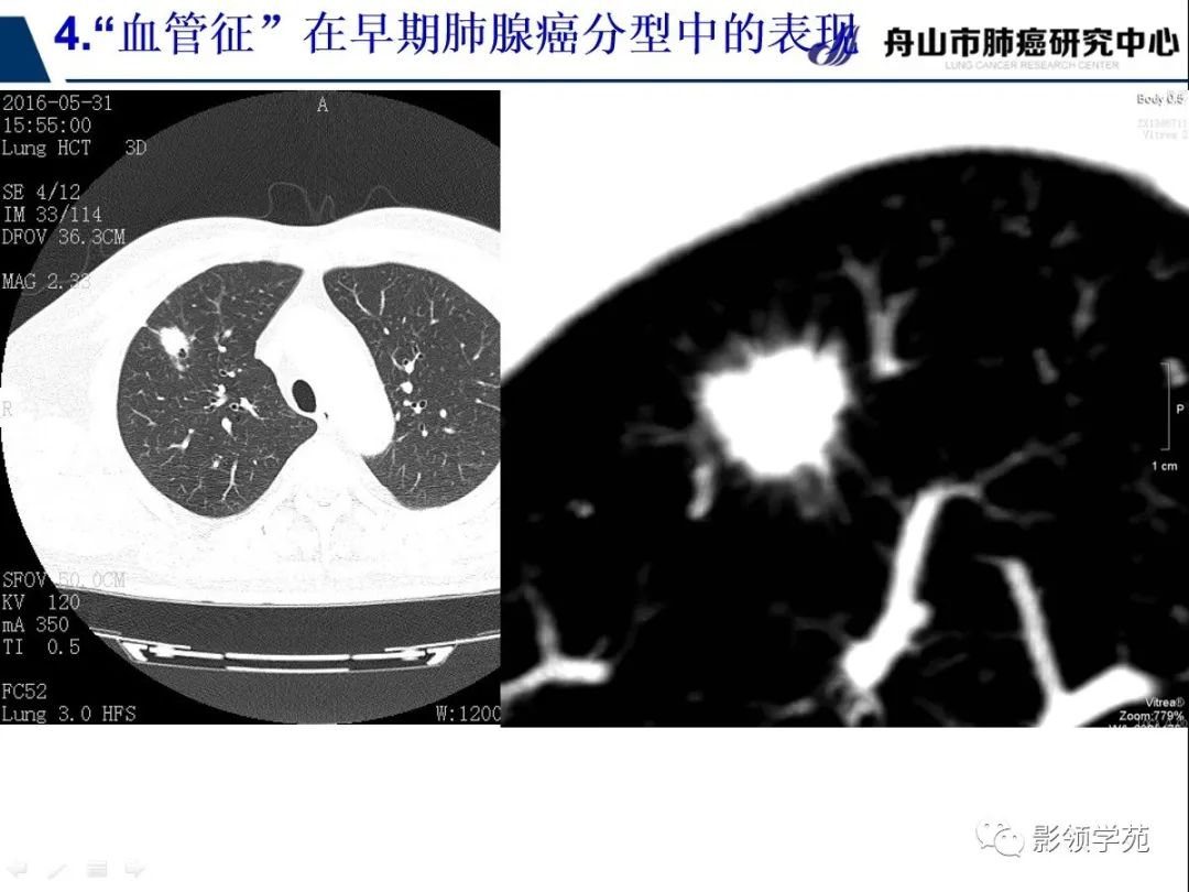 影像PPT - 【PPT】CT征象对早期肺腺癌亚型分型价值探讨—血管征-56 影像PPT - 【PPT】CT征象对早期肺腺癌亚型分型价值探讨—血管征-56