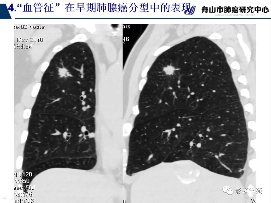 影像PPT - 【PPT】CT征象对早期肺腺癌亚型分型价值探讨—血管征-57 影像PPT - 【PPT】CT征象对早期肺腺癌亚型分型价值探讨—血管征-57