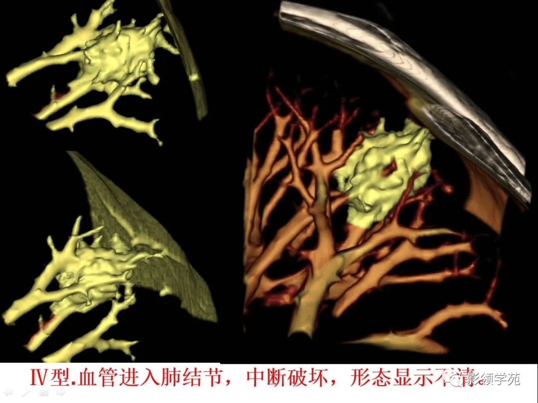 影像PPT - 【PPT】CT征象对早期肺腺癌亚型分型价值探讨—血管征-58 影像PPT - 【PPT】CT征象对早期肺腺癌亚型分型价值探讨—血管征-58