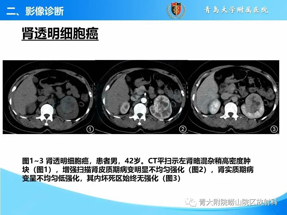 影像PPT - 【PPT】实性肾细胞癌的影像诊断与鉴别诊断-6