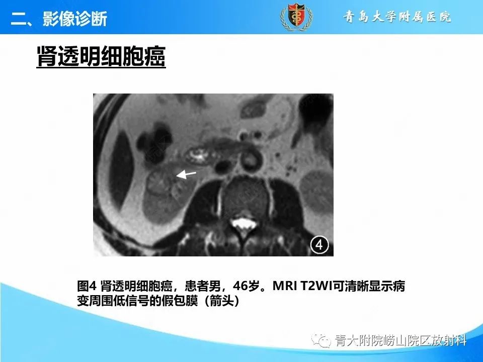 影像PPT - 【PPT】实性肾细胞癌的影像诊断与鉴别诊断-7