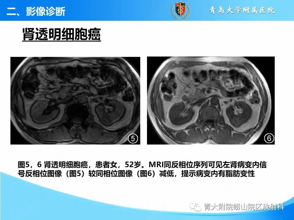 影像PPT - 【PPT】实性肾细胞癌的影像诊断与鉴别诊断-8