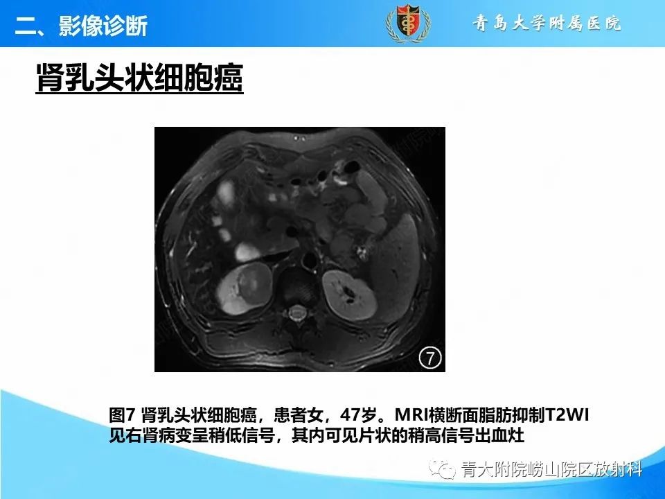 影像PPT - 【PPT】实性肾细胞癌的影像诊断与鉴别诊断-11
