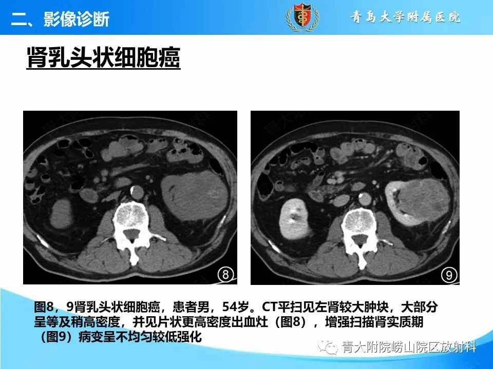 影像PPT - 【PPT】实性肾细胞癌的影像诊断与鉴别诊断-12
