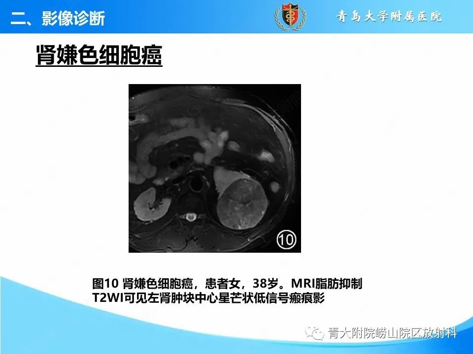 影像PPT - 【PPT】实性肾细胞癌的影像诊断与鉴别诊断-15
