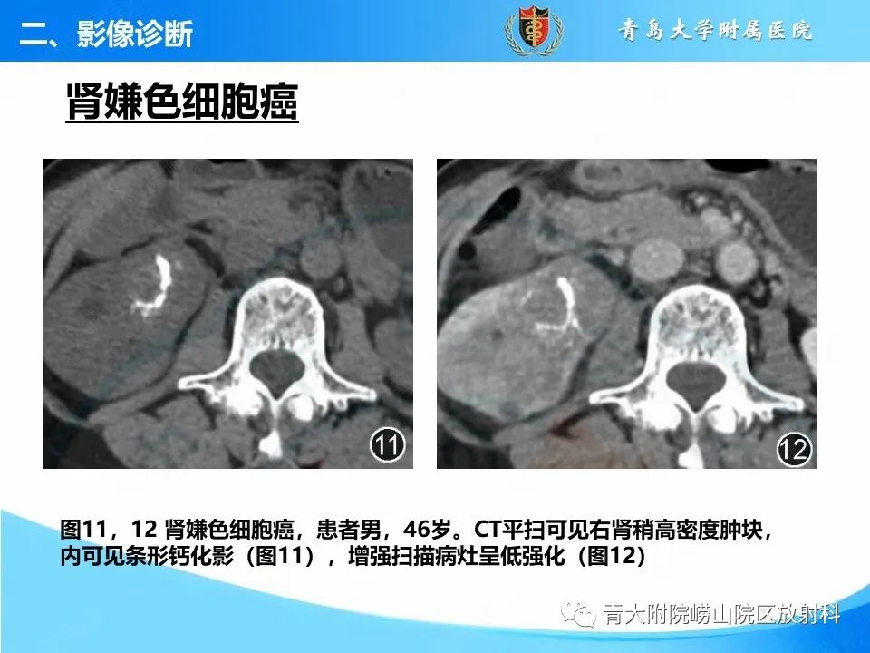 影像PPT - 【PPT】实性肾细胞癌的影像诊断与鉴别诊断-16