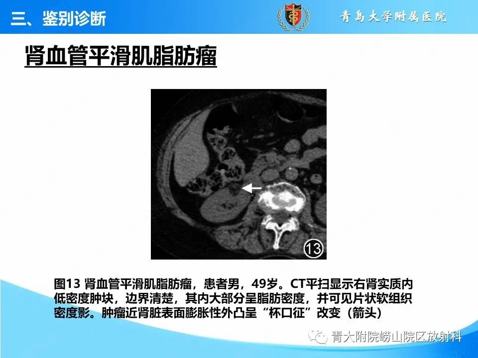 影像PPT - 【PPT】实性肾细胞癌的影像诊断与鉴别诊断-19