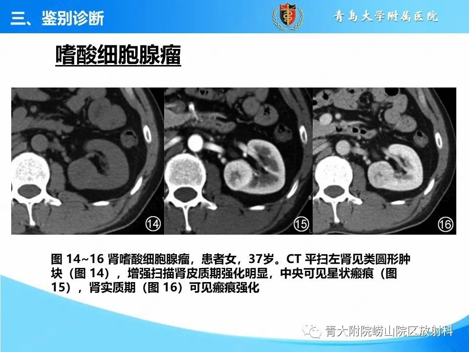 影像PPT - 【PPT】实性肾细胞癌的影像诊断与鉴别诊断-21