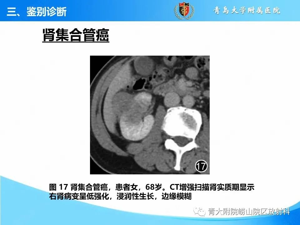 影像PPT - 【PPT】实性肾细胞癌的影像诊断与鉴别诊断-23