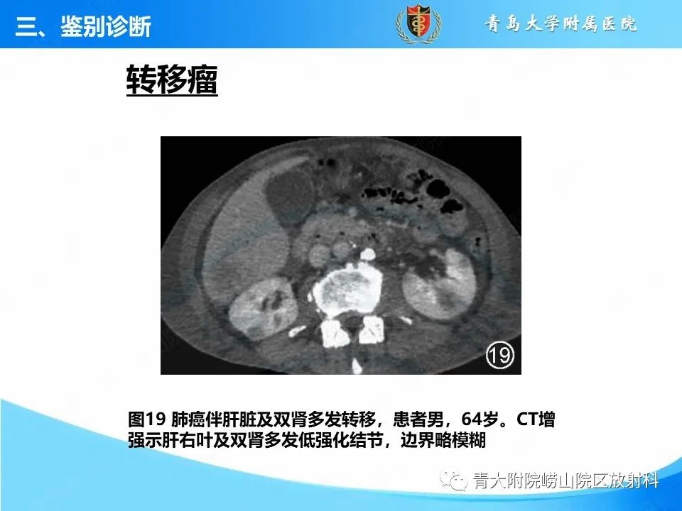 影像PPT - 【PPT】实性肾细胞癌的影像诊断与鉴别诊断-27