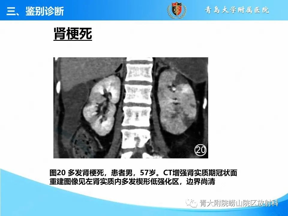 影像PPT - 【PPT】实性肾细胞癌的影像诊断与鉴别诊断-29