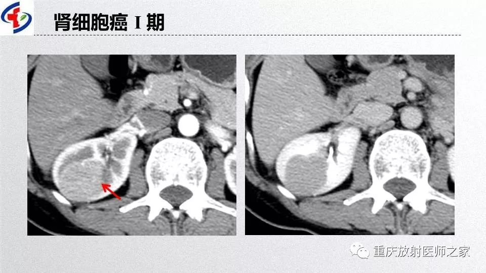 影像PPT - 【PPT】肾癌常见亚型的影像学表现及鉴别诊断-8