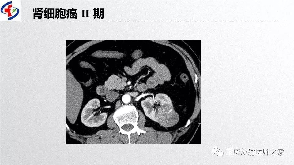 影像PPT - 【PPT】肾癌常见亚型的影像学表现及鉴别诊断-9