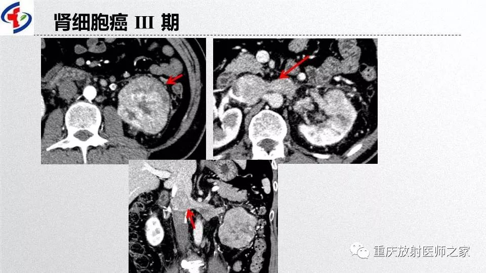 影像PPT - 【PPT】肾癌常见亚型的影像学表现及鉴别诊断-10