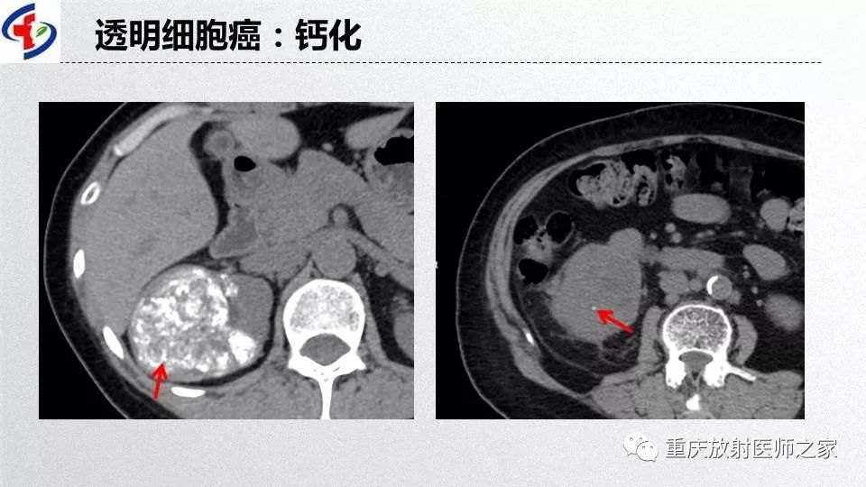 影像PPT - 【PPT】肾癌常见亚型的影像学表现及鉴别诊断-13