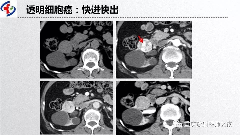 影像PPT - 【PPT】肾癌常见亚型的影像学表现及鉴别诊断-14