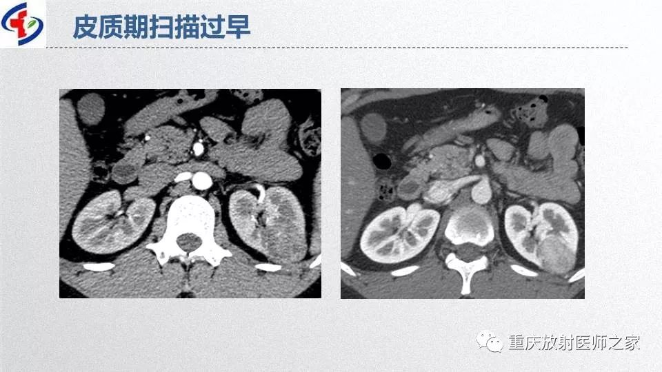 影像PPT - 【PPT】肾癌常见亚型的影像学表现及鉴别诊断-22