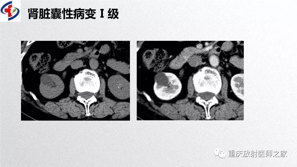 影像PPT - 【PPT】肾癌常见亚型的影像学表现及鉴别诊断-35