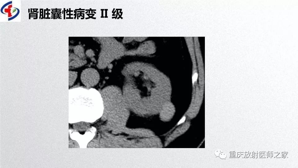 影像PPT - 【PPT】肾癌常见亚型的影像学表现及鉴别诊断-36
