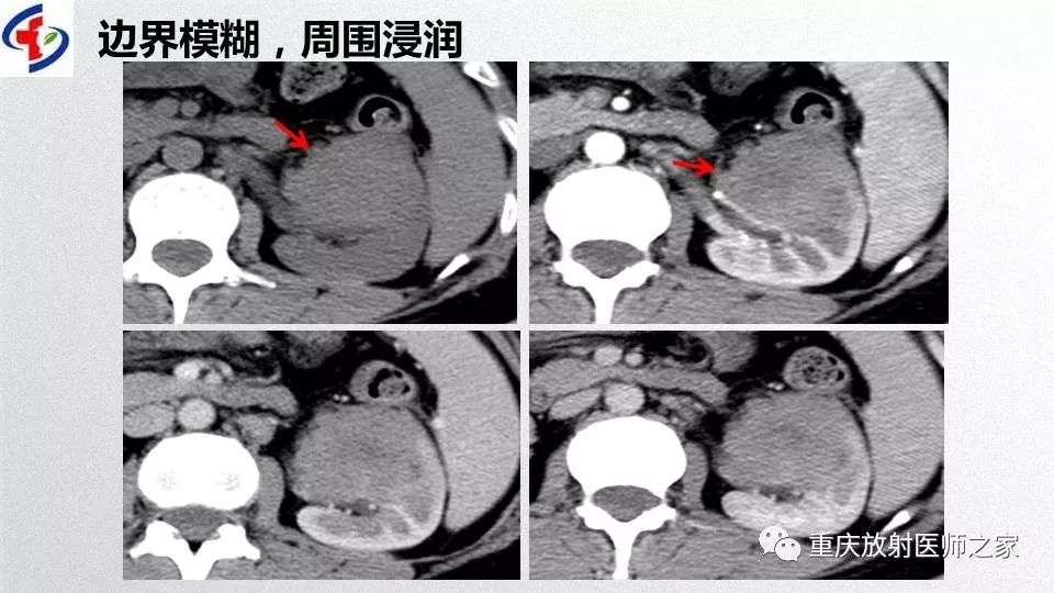影像PPT - 【PPT】肾癌常见亚型的影像学表现及鉴别诊断-45