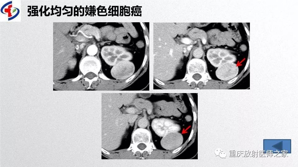 影像PPT - 【PPT】肾癌常见亚型的影像学表现及鉴别诊断-52