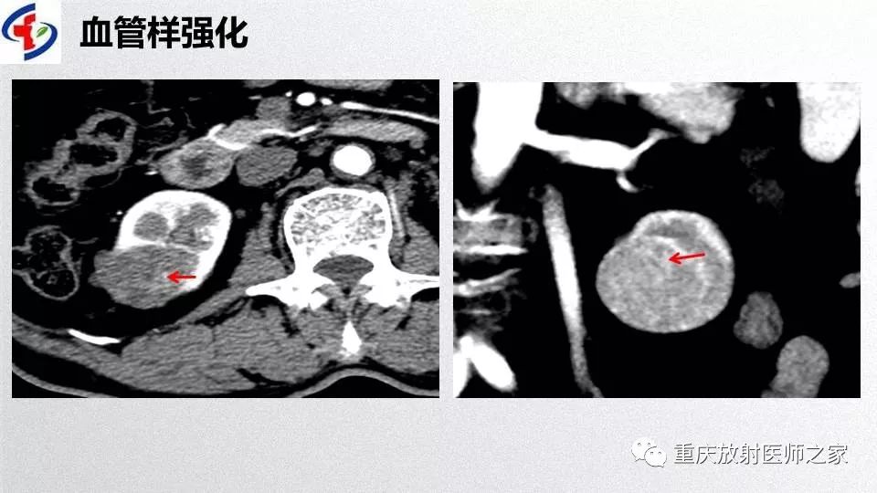 影像PPT - 【PPT】肾癌常见亚型的影像学表现及鉴别诊断-53