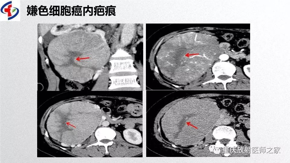 影像PPT - 【PPT】肾癌常见亚型的影像学表现及鉴别诊断-55